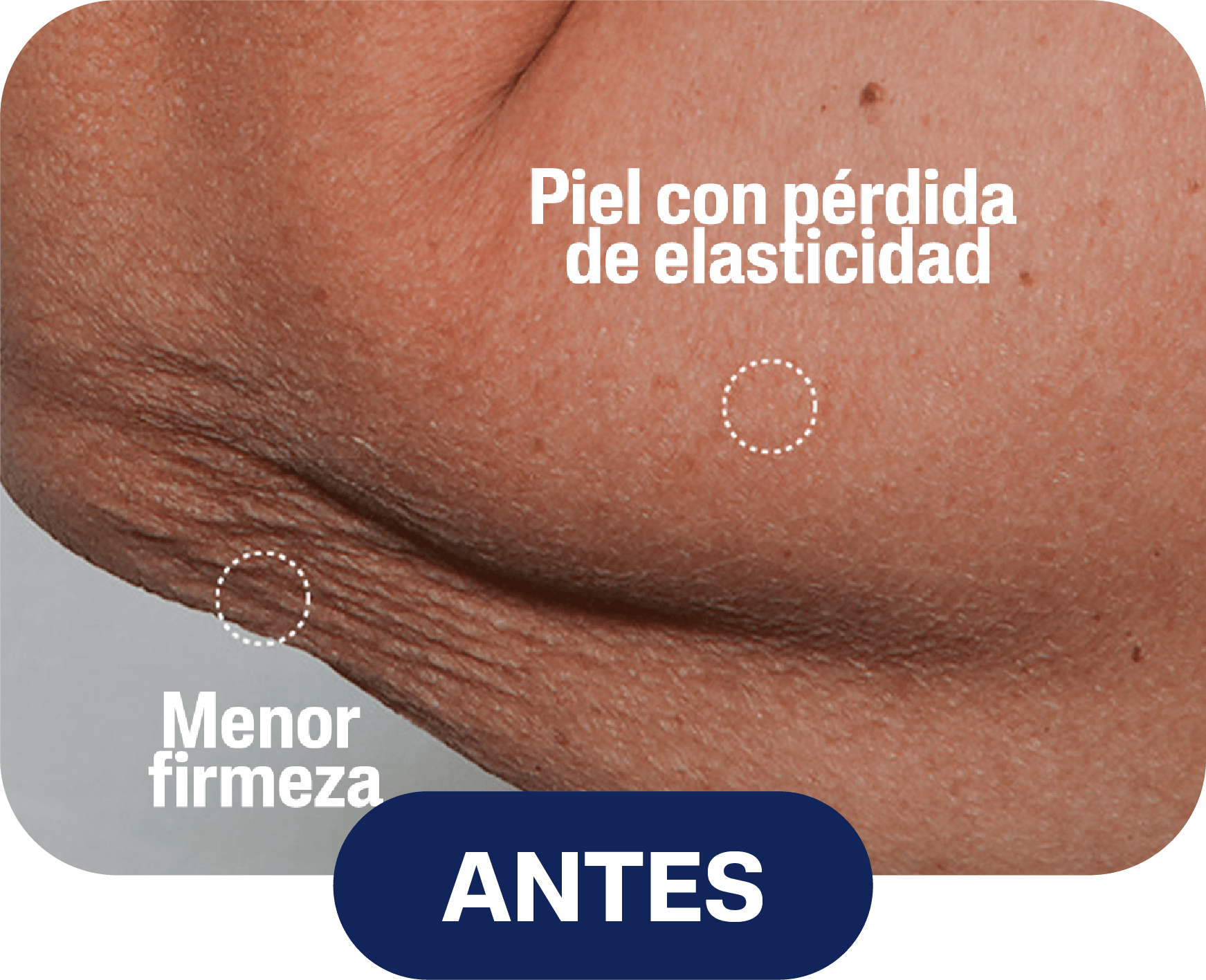 Antes